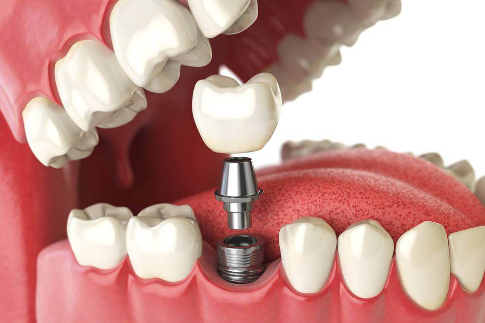 Che cos’è un impianto dentale?
